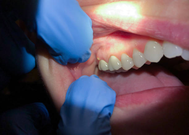 Best Emergency Wisdom Teeth Removal in Otsego, MN